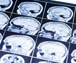 Tracking changes in blood vessels may hold clues to early detection of neurodegenerative diseases
